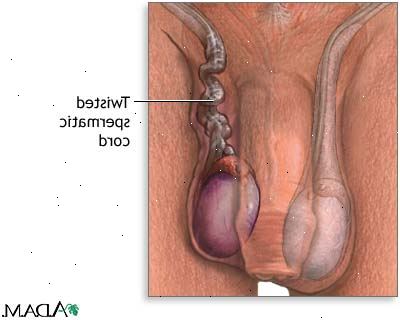 Vad händer i en torsion (vridning) i testiklarna? Vem får vridning av testiklarna?