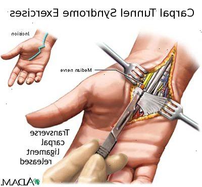 Vad är karpaltunnelsyndrom? Bone eller artritiska tillstånd av handleden.