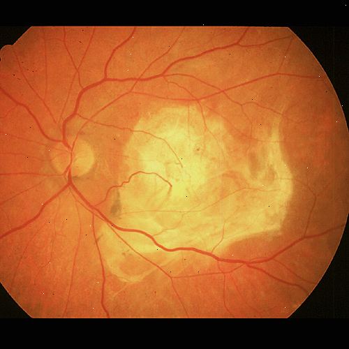Att förstå den bakre delen av ögat. Alltid se en läkare eller optiker omedelbart om du utvecklar synbortfall eller visuell distorsion. Att förstå den bakre delen av ögat. Alltid se en läkare eller optiker omedelbart om du utvecklar synbortfall eller visuell distorsion.
