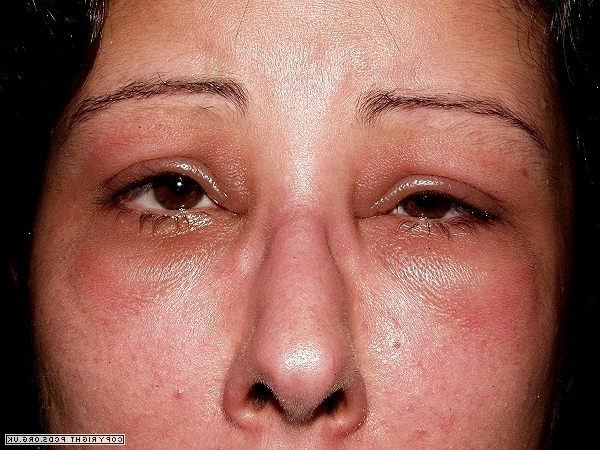 Vad orsakar angioödem? Icke-allergisk reaktion mot ett läkemedel.