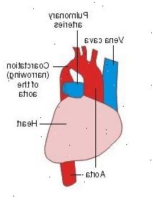 Hur vanligt är aortakoarktation? Vilka är symtomen på aortakoarktation?