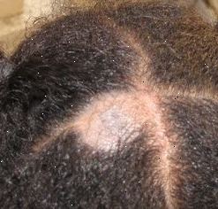 Svamp hårbotten infektion (hårbotten ringorm). De flesta fall av hårbotten ringorm fångas från person till person.