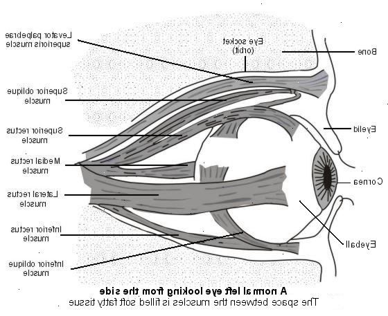 Sköldkörtel ögonsjukdomar. Komplikationer från sjukdomen.