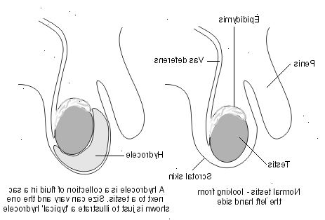Hydrocele hos barn. Den normala pungen och testiklarna.