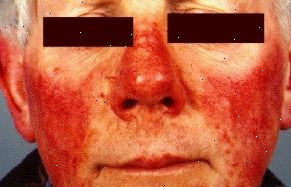 Vad är rosacea och vad är symptomen? Förtjockning av huden.