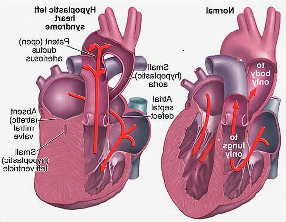 Hjärt-syndrom X. Vad är hjärt syndrom x?