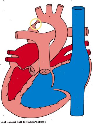 Hur aortakoarktation diagnosen? Vad är behandlingen för aortakoarktation?