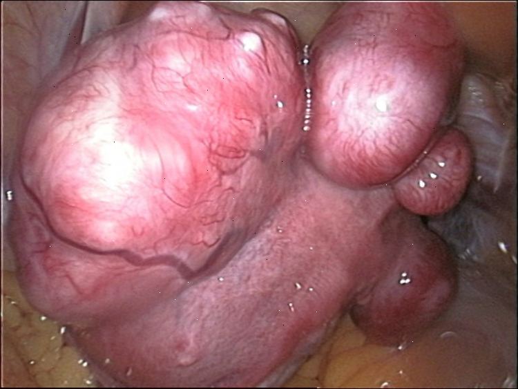 Vilka symptom och problem orsakas av myom? Levonorgestrel intrauterint system (LNG-ius).
